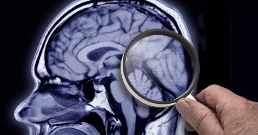 Demans ve Alzheimer: belirtileri nelerdir, hangi tedaviler kullanılıyor?  – Son dakika sağlık, hayat haberleri