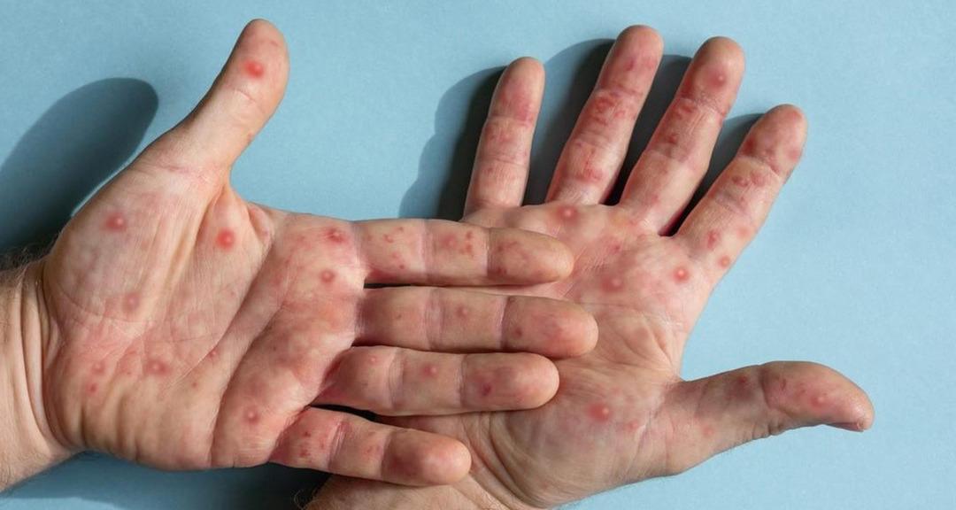 DSÖ M-pox Virüsü Uyarısı: Salgın kıtayı aştı! Kontrol altında tutmak 2