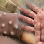 DSÖ M-pox Virüsü Uyarısı: Salgın kıtayı aştı! “Kontrol altında olmalı”