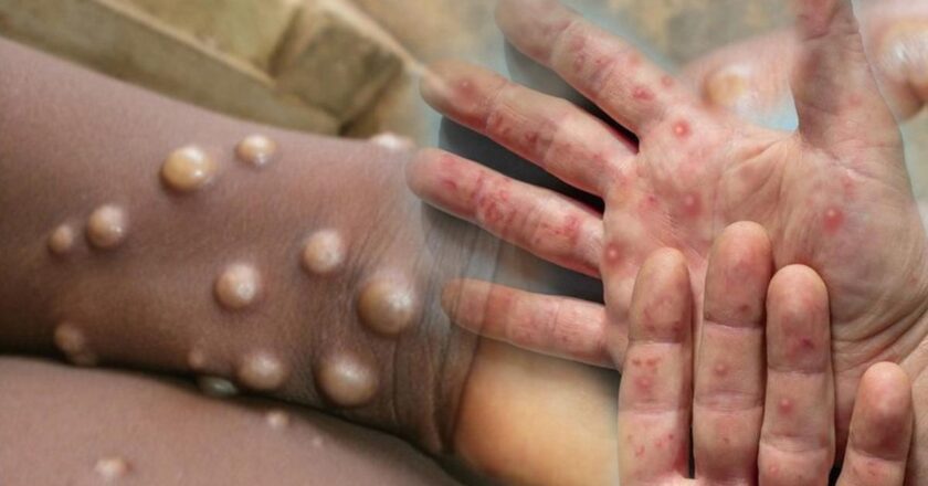 DSÖ M-pox Virüsü Uyarısı: Salgın kıtayı aştı! “Kontrol altında olmalı”