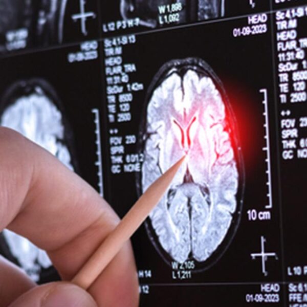 Çok nadir görülen yeni bir nörolojik hastalık keşfedildi: Sadece 13 kişide görüldü!